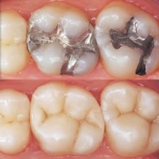 انواع روش های ترمیم دندان